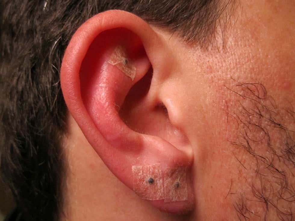 Dấu hiệu nhiễm trùng khi bấm lỗ tai và cách điều trị